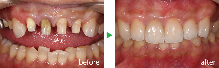 症例1のbefore-after