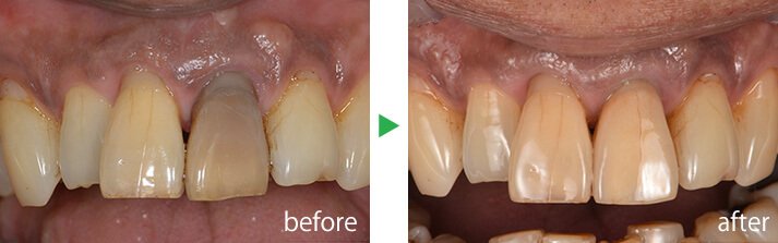 症例2のbefore-after