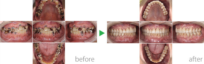 症例4のbefore-after