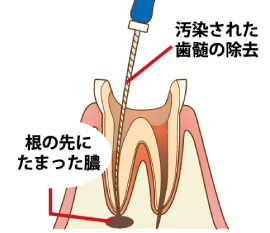 歯の神経の除去イメージ