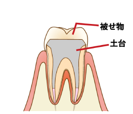 歯科用セメントのセット