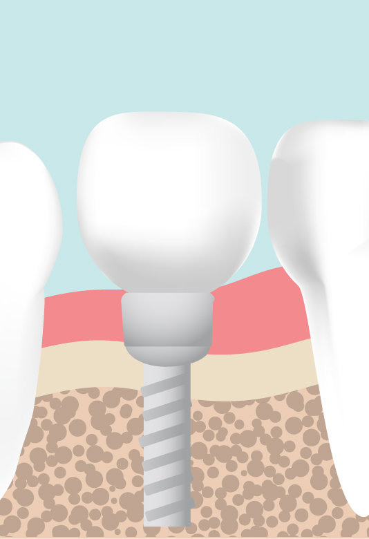 インプラント治療