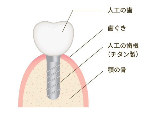第2の永久歯となる「インプラント治療」